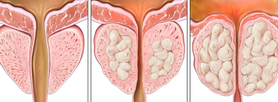 Etapas de prostatitis