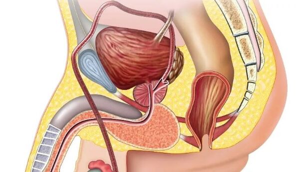 Prostatitis crónica
