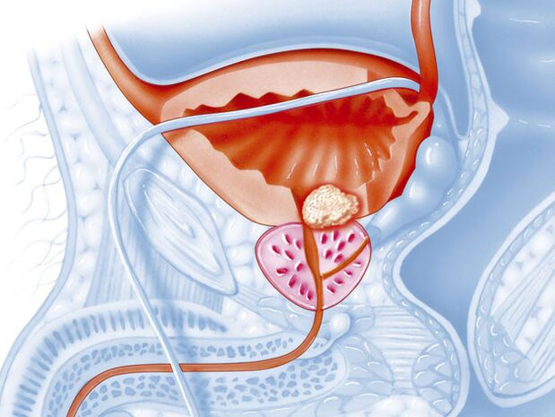 La forma bacteriana de la prostatitis