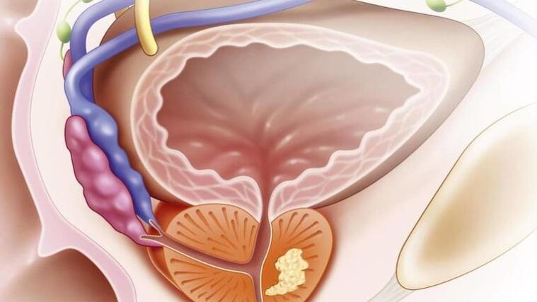 Prostatitis crónica